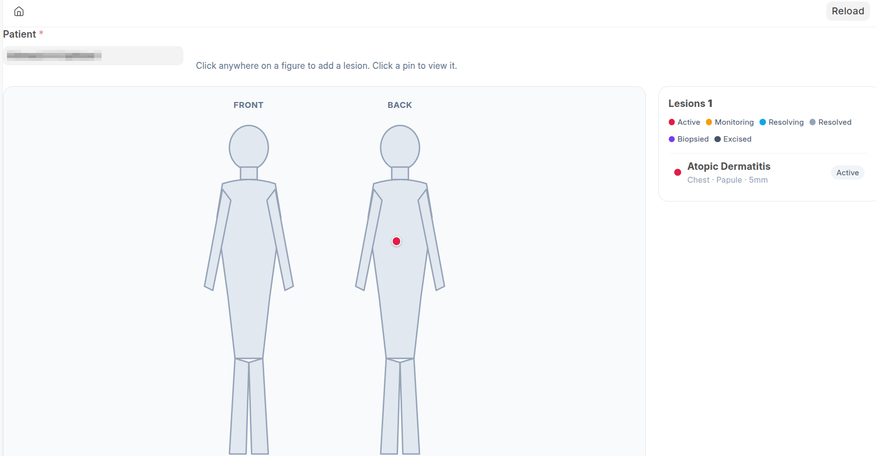 Dermatology body map: front and back figures with a pinned lesion, listed by site, type, size and status.